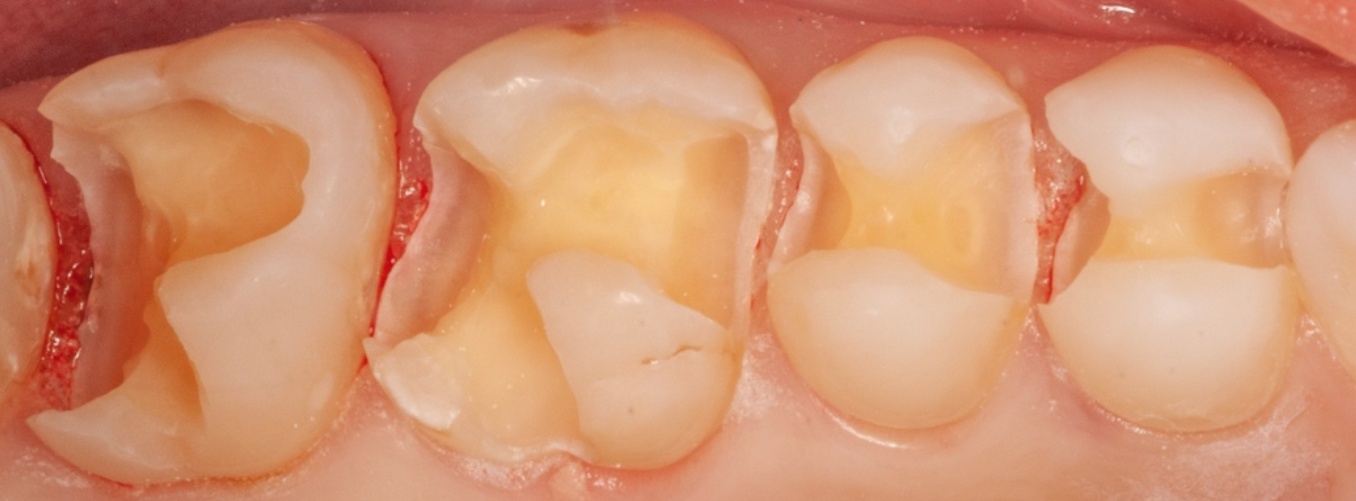 teeth after minimally invasive dentistry