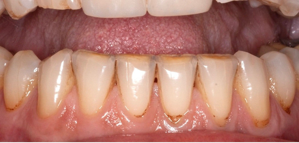 enamel has been completely worn away on teeth