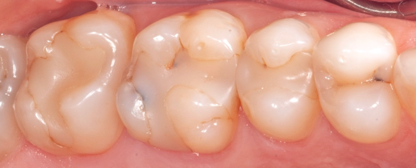 teeth before minimally invasive dentistry