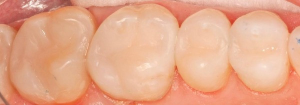 minimally-invasive dentistry