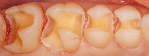 healthy tooth enamel after filling removal