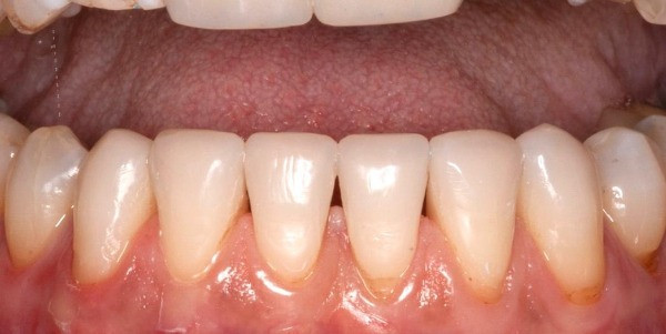 after minimally invasive dentistry